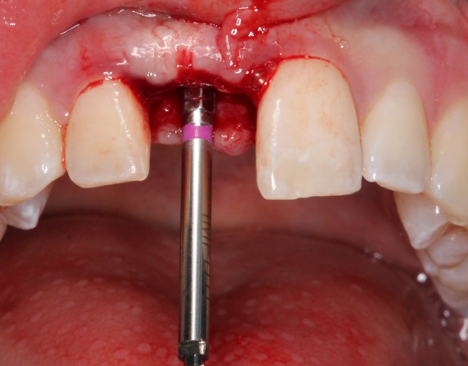 Treatment planning implants 25 year old female with internal root