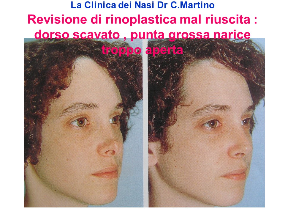 La Clinica Dei Nasi Dr Martino Salerno Rinoplastica Secondaria Casi Tipici La Clinica Dei Nasi Dr C Martino
