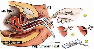 pap-smear-test-in-hindi-language