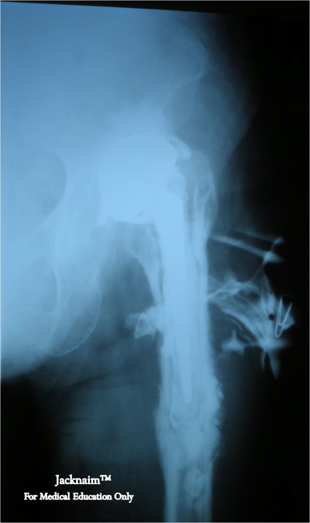 My Medical Notes Bone infection