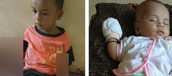 Muhammad Haikal Nasution dan adiknya Habibah Zakira Nasution yang menderita kulit melepuh. Muhammad Haikal Nasution dan adiknya Habibah Zakira Nasution yang menderita kulit melepuh.