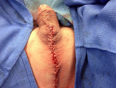 Orchi-Post-Scrotectomy.jpg