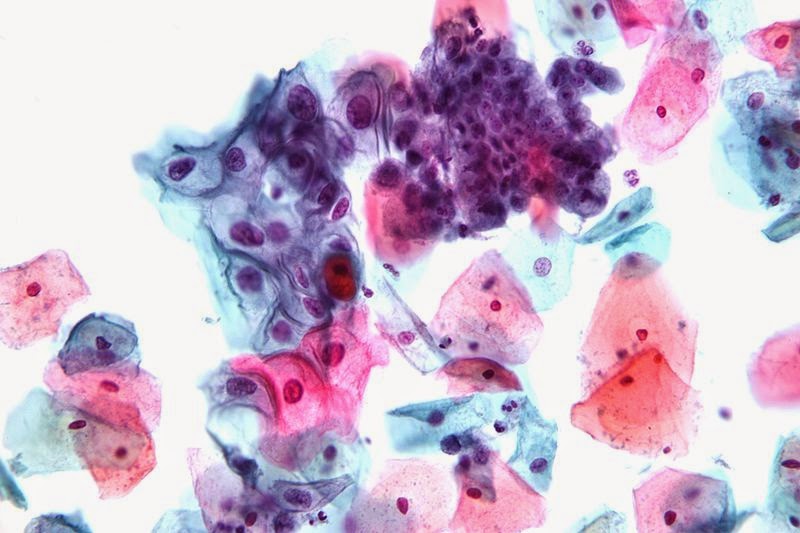 Best of Anal pap smear results Man licking womens clit