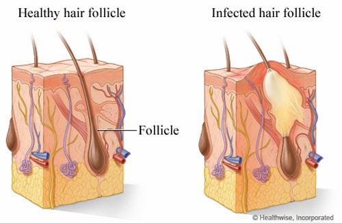 Can razor burn folliculitis spread? - WebMD Answers