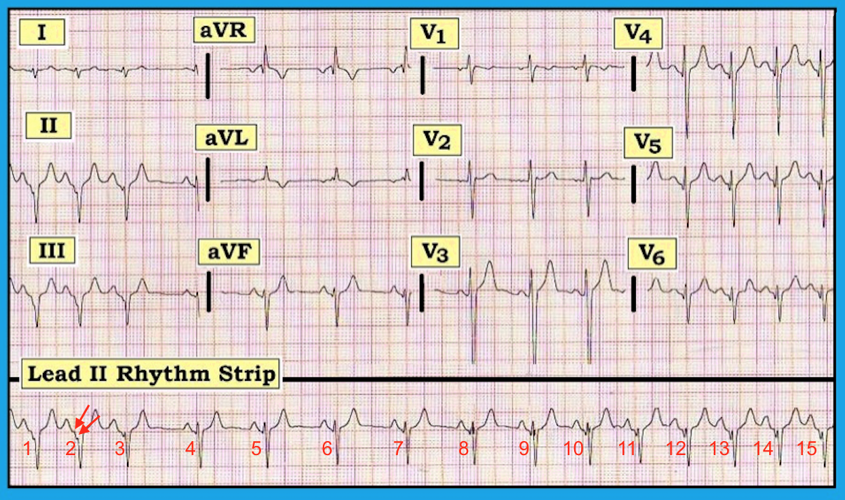 ECG Interpretation ECG Blog 121 (Arrhythmia — multiple Q waves — WPW