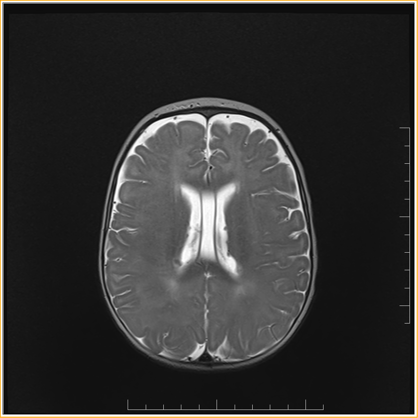 Tuberous SclerosisMRI Sumer's Radiology Blog