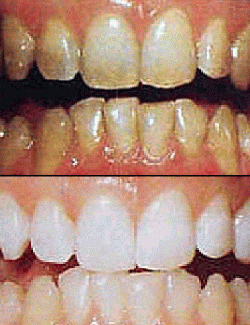 Does Black Magic Effect The Teeth 82