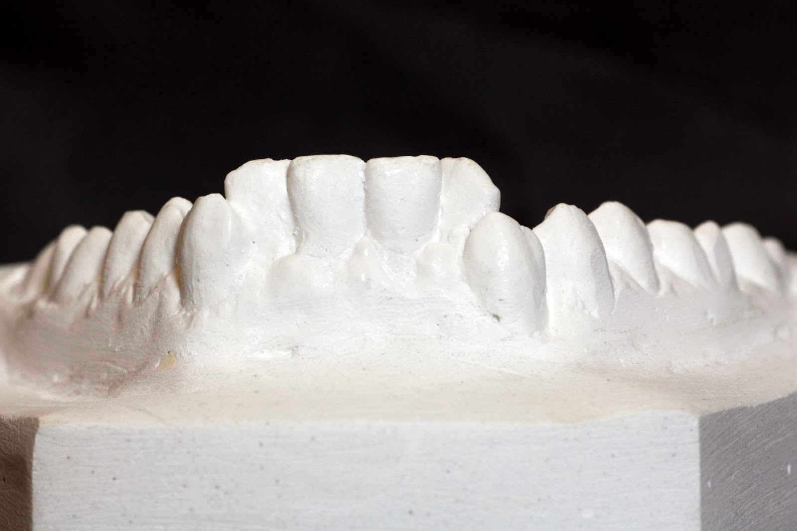 Orthodontics UG Model Analysis Position of teeth