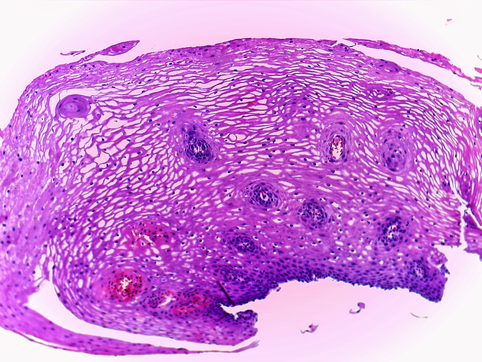Меланома микропрепарат рисунок