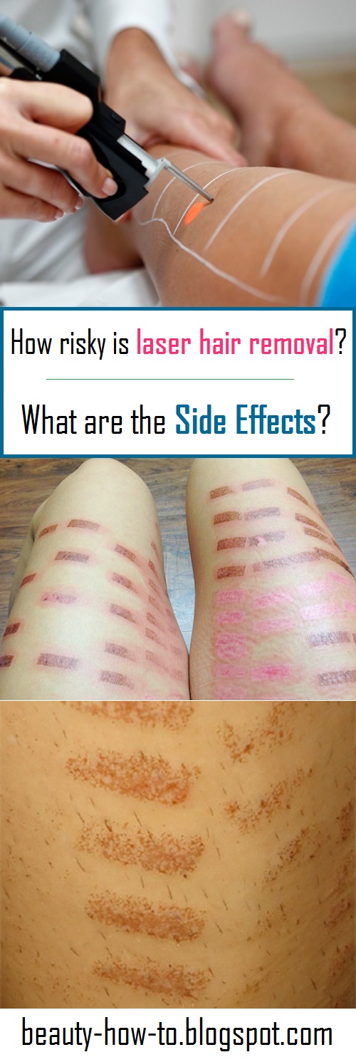 How risky is laser hair removal? What are the side effects? How To Beauty