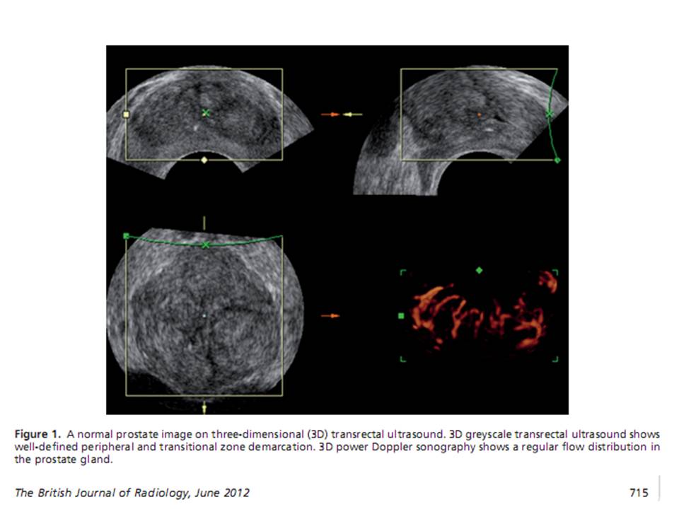 Trus Scan BÀI SOẠN VỀ SIÊU ÂM CHẨN ĐOÁN: 3D Transrectal Ultrasound of Prostate Cancer