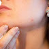 How To Prevent Pimples Naturally At Home