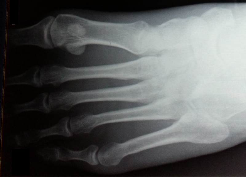 Running the Sahara Marathon Metatarsal Stress Fracture Scare
