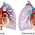 Bezdech senny i zastosowanie CPAP przy nadciśnieniu płucnym (PAH)