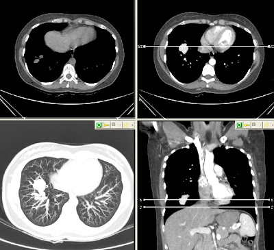 Pulmonary manifestation of Osler-Weber-Rendu disease