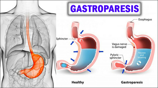 herbal remedies for gastroparesis, gastroparesis natural treatment