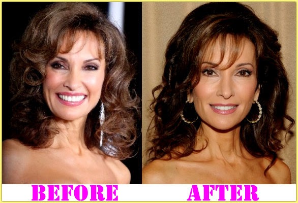 Susan Lucci Plastic Surgery.