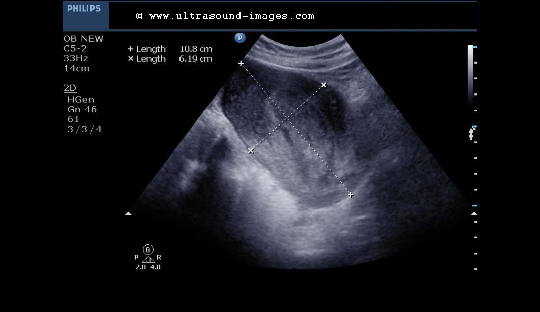 cochinblogs Sonography retained products of conception