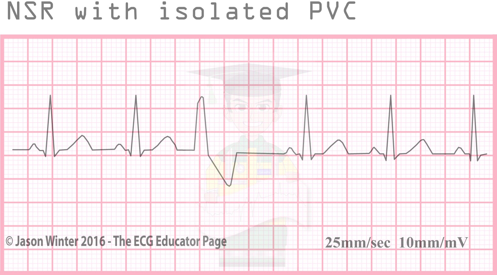 ECG Educator Blog Ventricular Ectopics
