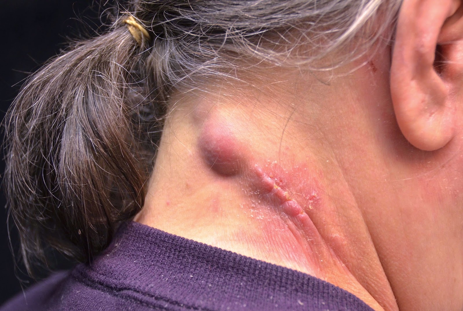 skin abscess pictures