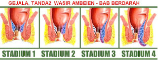 obat herbal ambeien paling ampuh