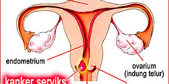 Mengenal Kanker Serviks atau Kanker Mulut Rahim