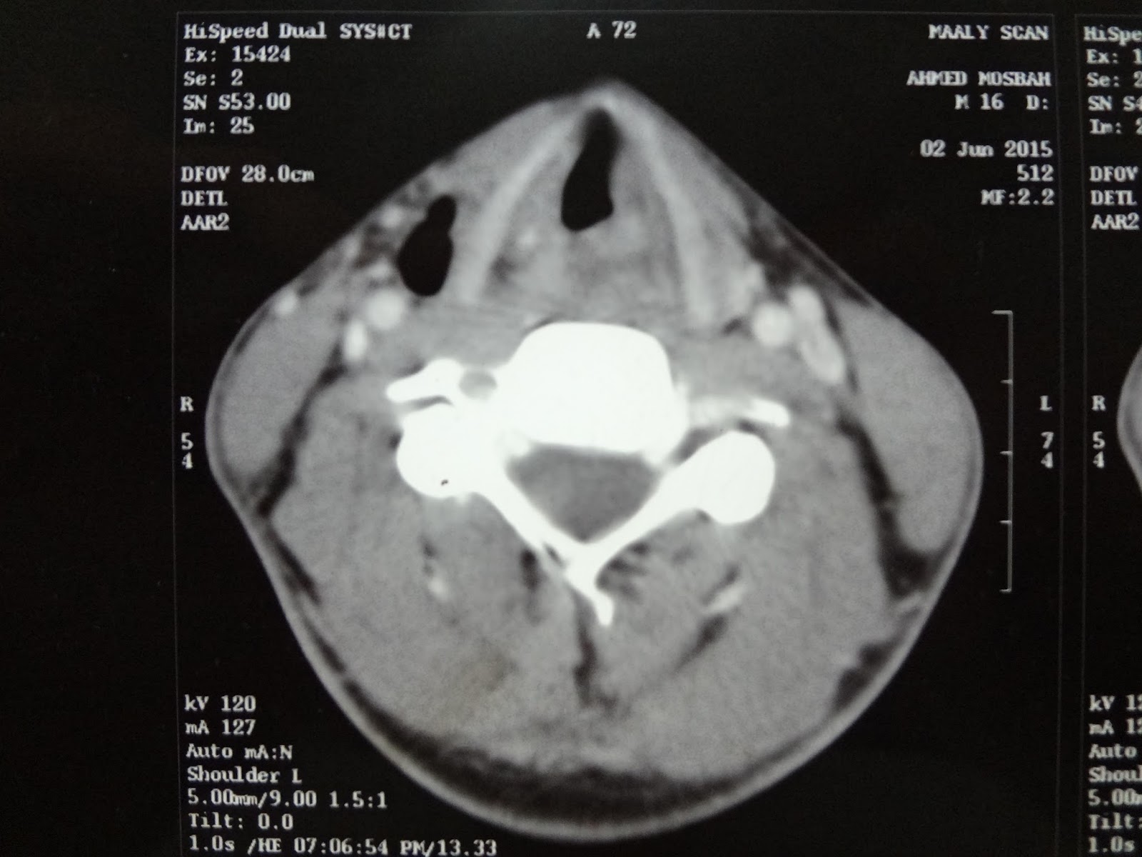 laryngeal tracheal stenosis grade IV . UPPER airway stenosis due to