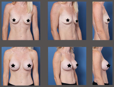 silicone nos seios antes e depois silicone nos seios antes e depois