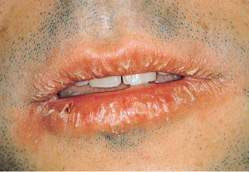 Lip Lesions Pictures, Images & Photos | Photobucket