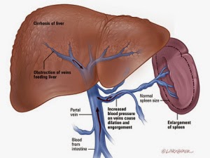 Gejala Pencegahan dan Pengobatan Penyakit Liver