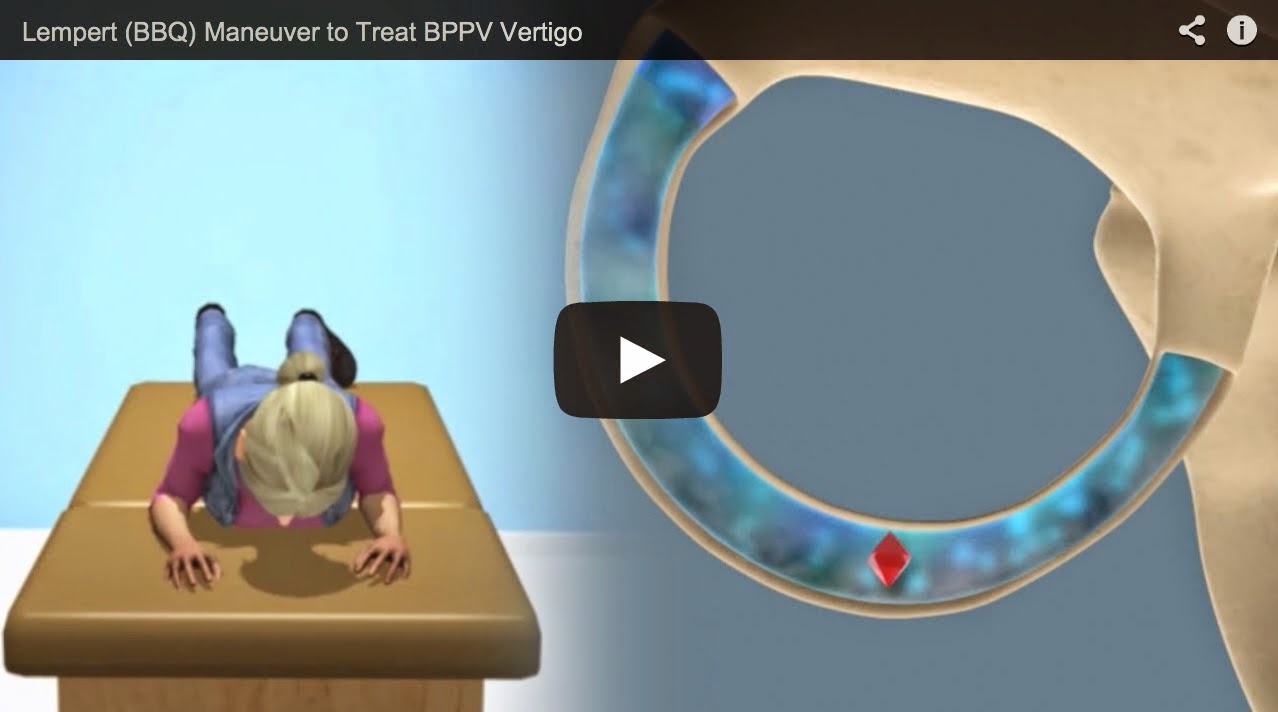 Video of Lempert (BBQ Roll) to Treat BPPV (Horizontal