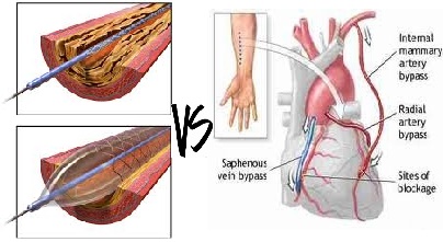 angioplastia coronaria
