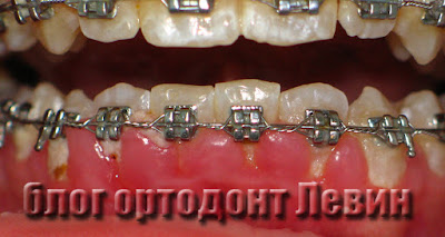 Осложнения лечения брекетами - гингивит