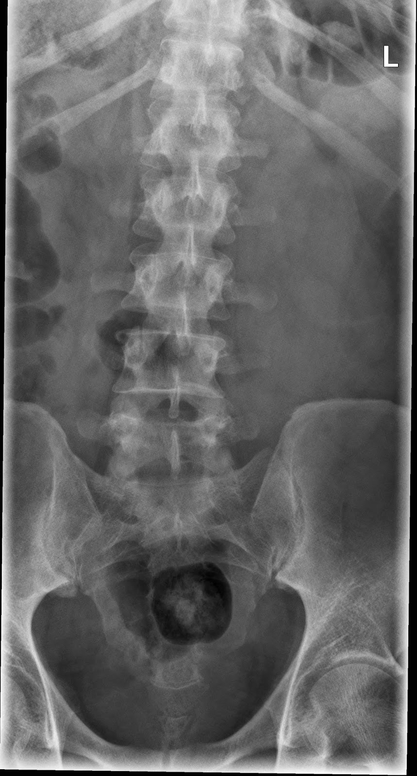 What Does A Normal Lumbar Spine X Ray Look Like Design Talk