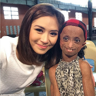 Progeria-suffering Asian girl Ana, 18, with 144 years old woman's body