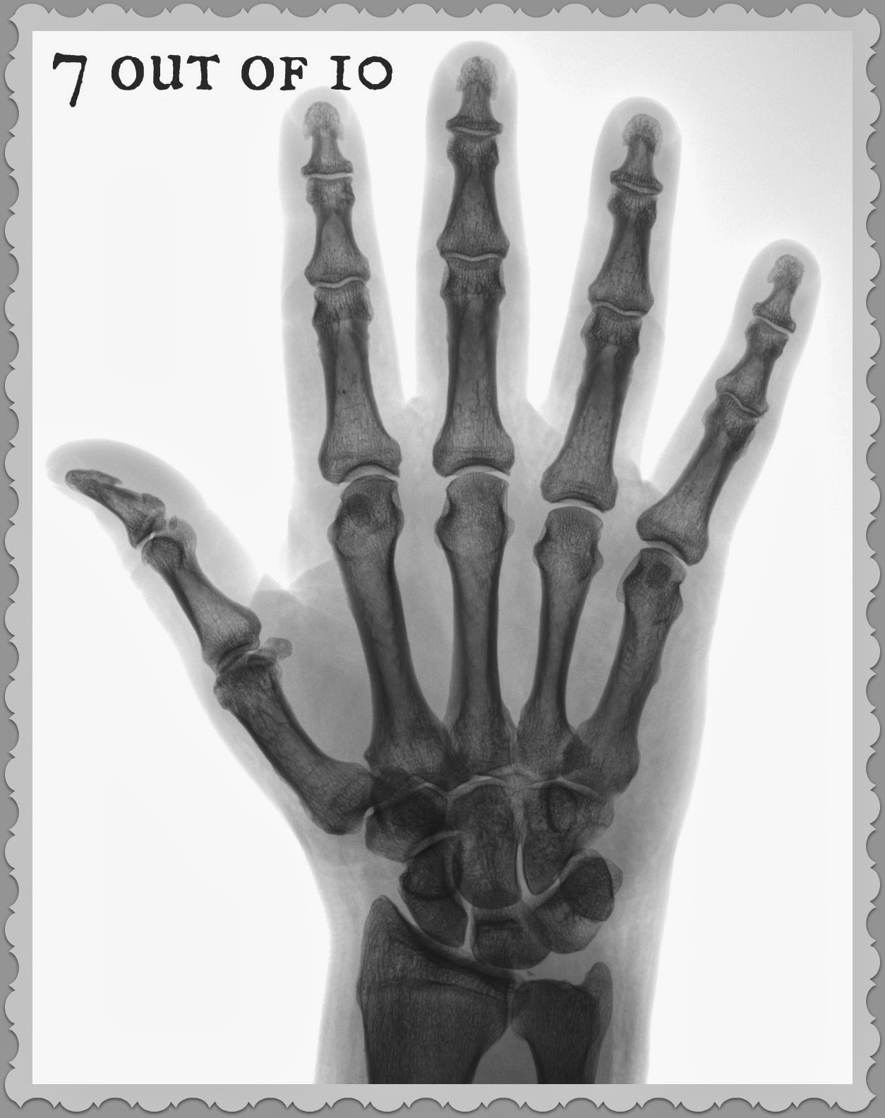 Nail Bites Contracted 2013 nail-bites-contracted-2013