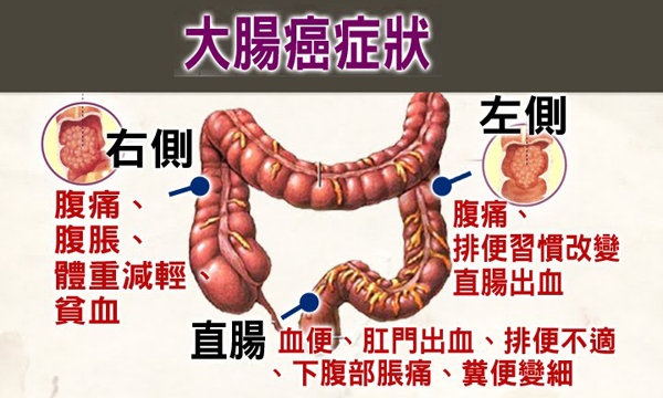 基因突變致大腸癌　息肉切除恐再復發