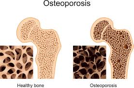 http://drsantpure.com/osteoporosis.html