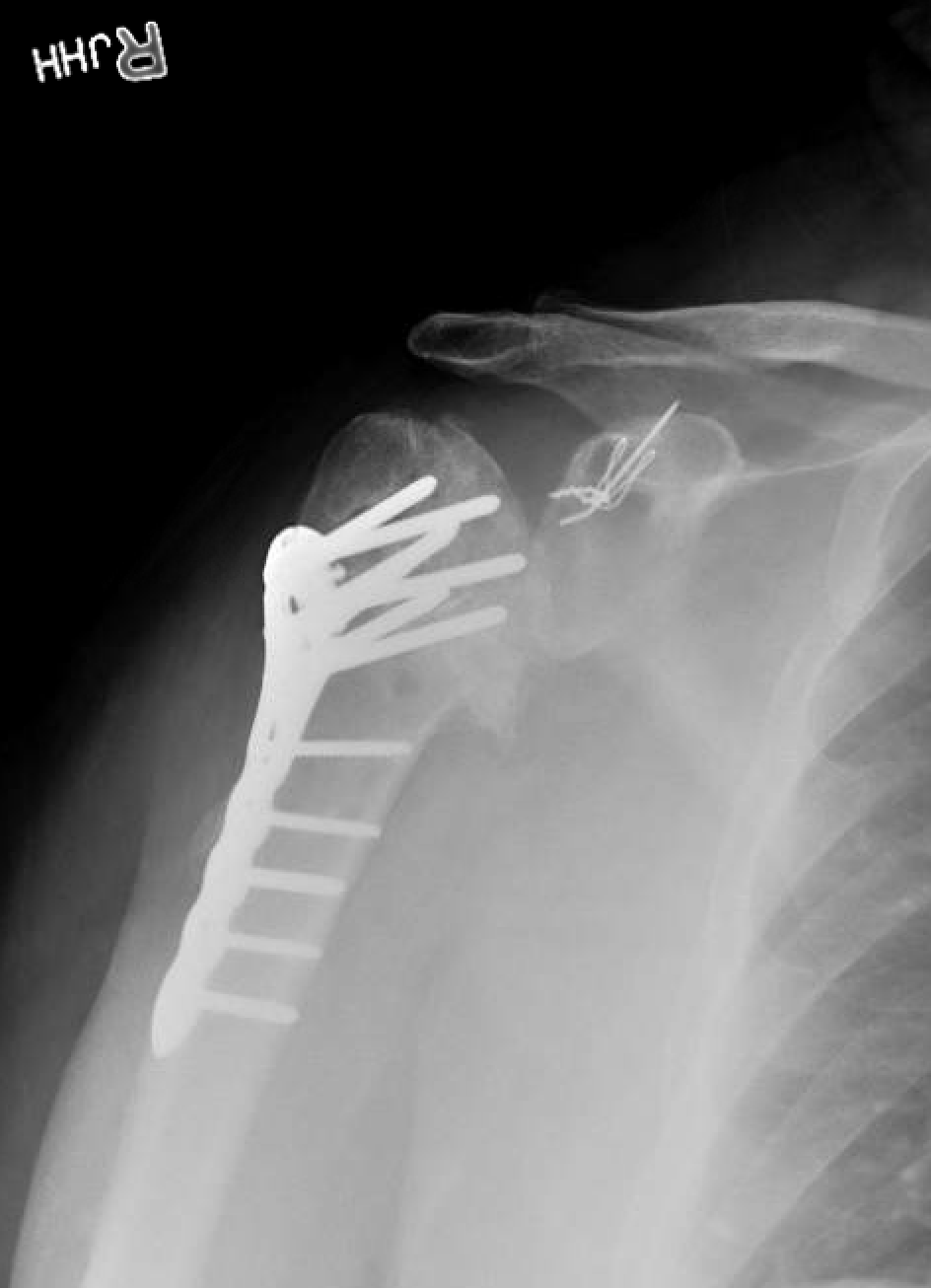 Shoulder and Elbow Surgery Short stems in the treatment of post