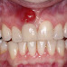 WHAT YOU NEED TO KNOW ABOUT STUBBORN GUM INFECTION, GINGIVITIS. (READ) 