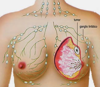 obat tumor payudara alternatif stadium 2, obat kanker payudara alami stadium 1, pengobatan alami kanker payudara stadium 1