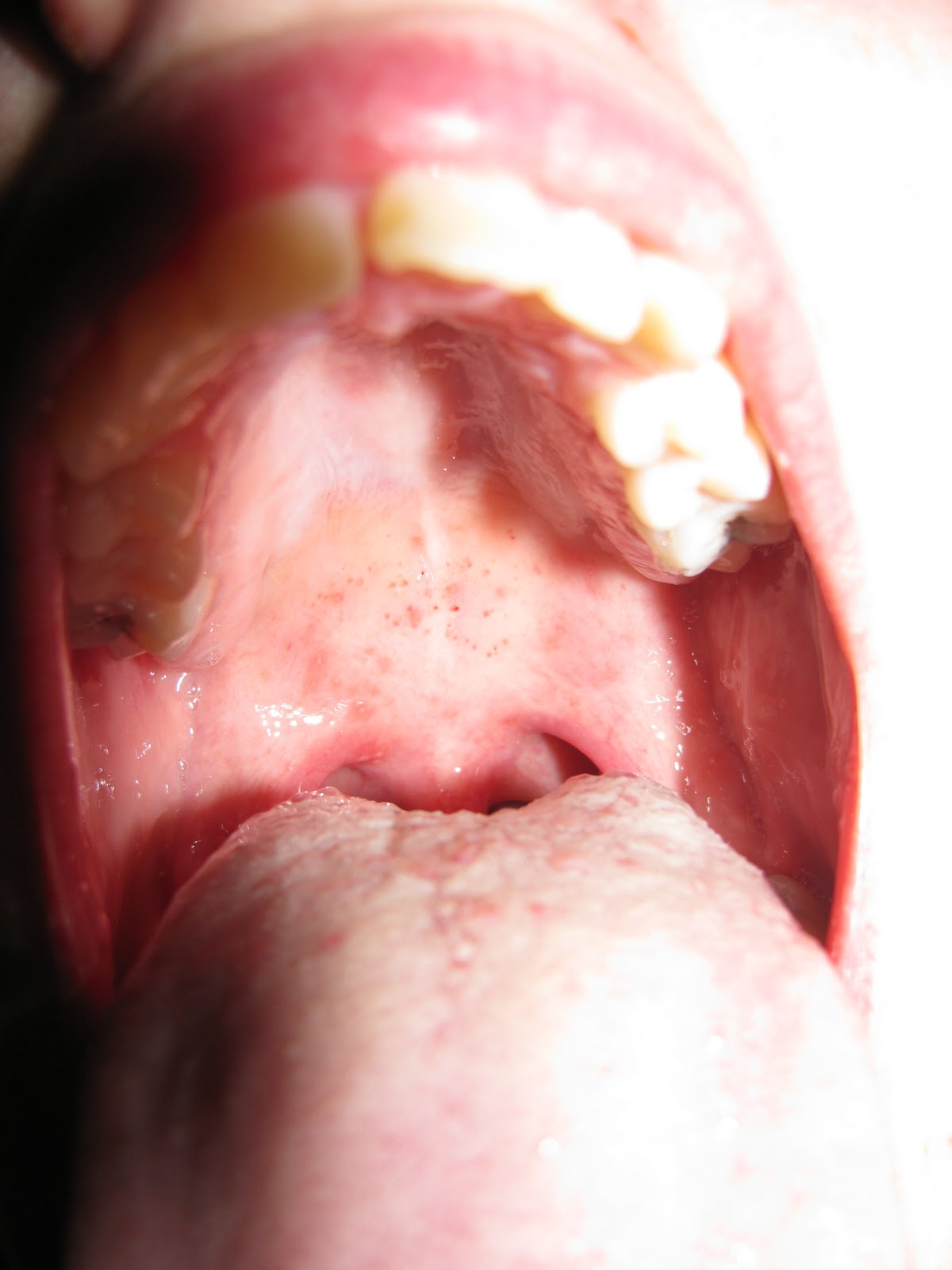 Throat Desease 23