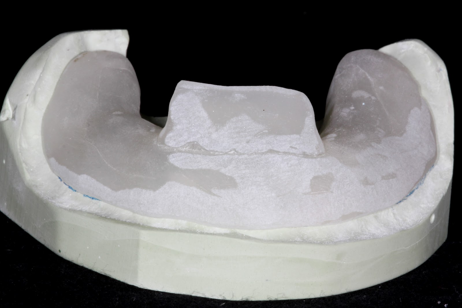 Boise Idaho Prosthodontics Edentulous Custom Tray for PVS Impression