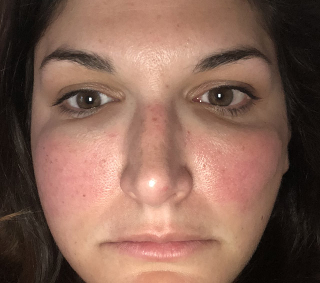 Review (with pictures) Excel V Laser for rosacea treatment and facial