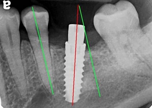 CẮM GHÉP IMPLANT KHÔNG ĐÚNG QUY TRÌNH VÀ NHỮNG BIẾN CHỨNG -1