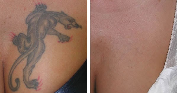 Laser Tattoo Removal Before And After Laser Tattoo Removal
