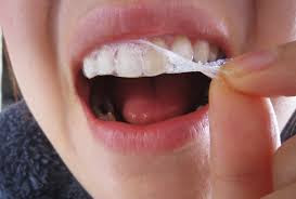 Miếng dán trắng răng cũng là giải pháp giúp loại bỏ mảng bám ố vàng trên răng