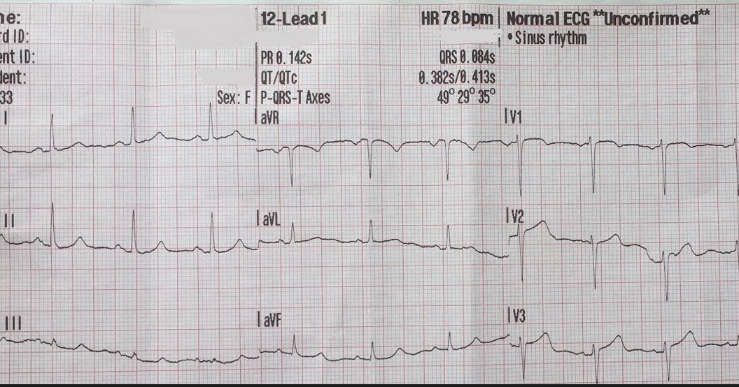 Dr. Smith's ECG Blog 30 yo woman with chest pain and a "normal ECG" by