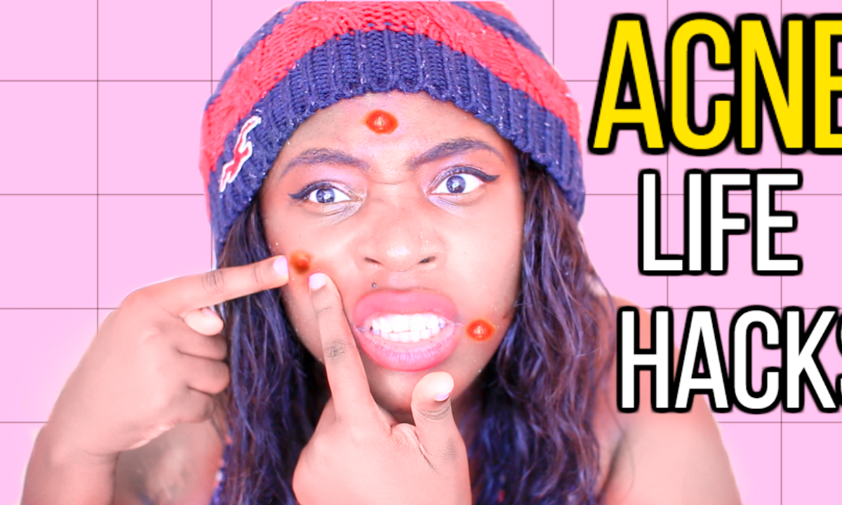 5 Acne & Pimple Life Hacks That Work Fast & Overnight