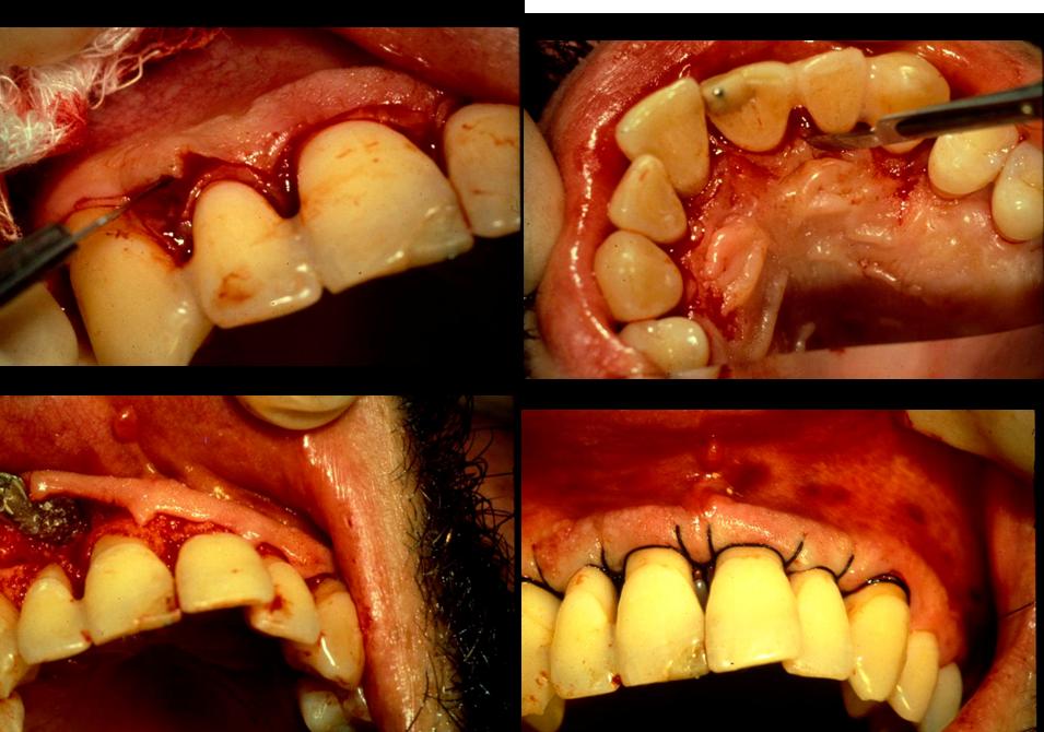 Flap surgery - definition of flap surgery by The Free ...